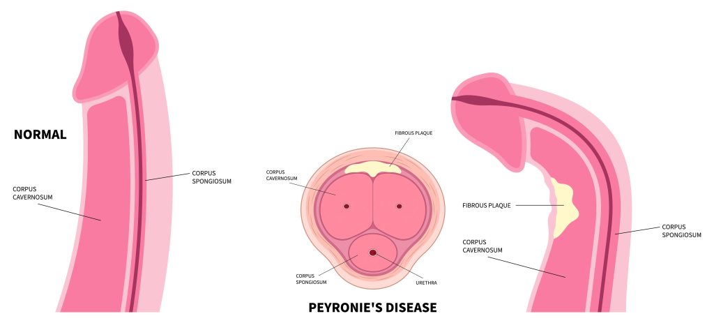 Ziekte van peyronie